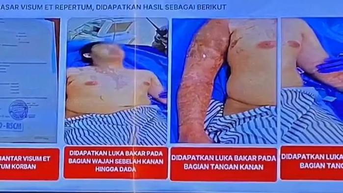 Aktivis KontraS Andrie Yunus Dirawat Intensif di RSCM Usai Disiram Air Keras